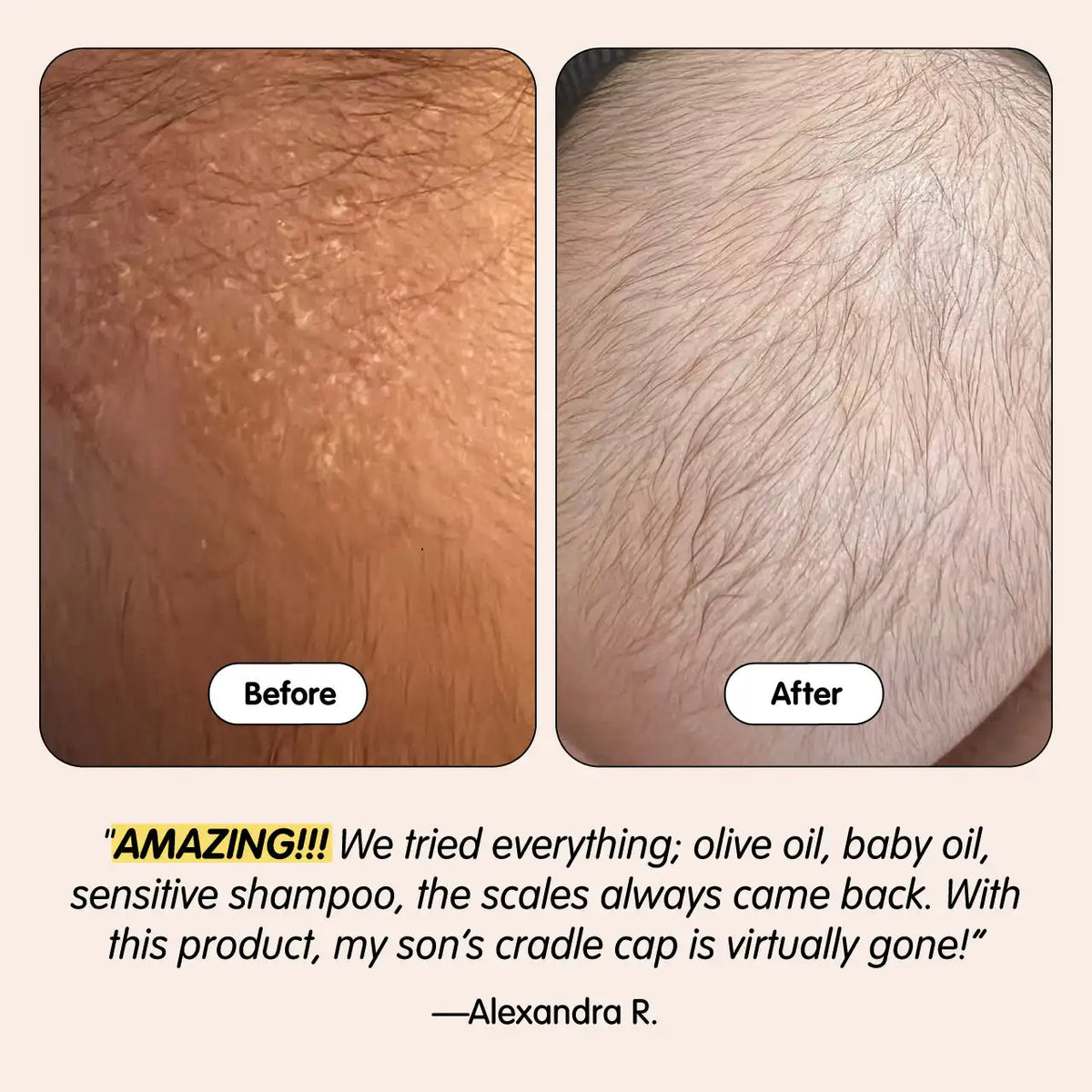 Bye-Bye Cradle Cap